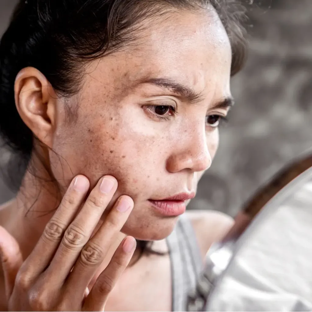 Melasma: rotina baseada em evidência, não em achismo e moda.